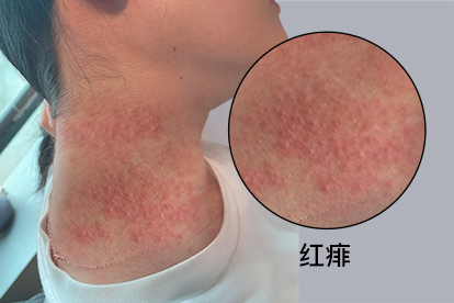 大人长痱子怎么治疗