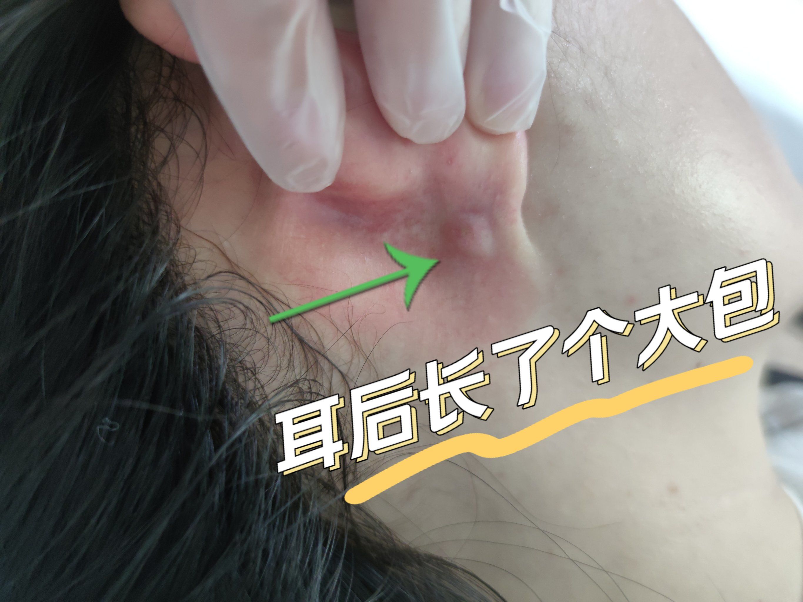 耳朵后面长了个疙瘩按会疼