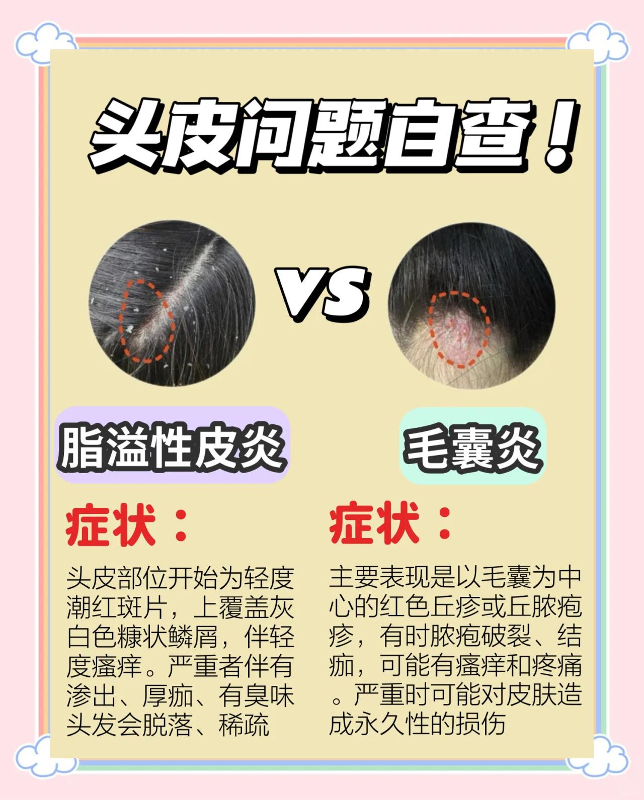为什么会患上脂溢性皮炎?