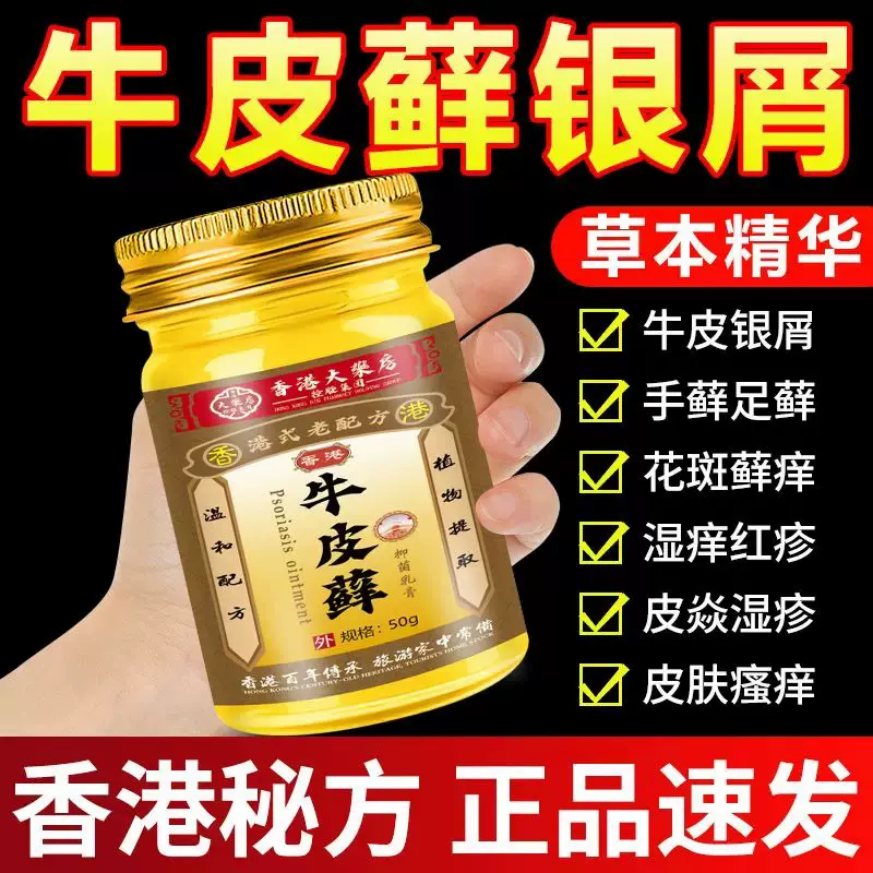 头癣用什么药膏最好?