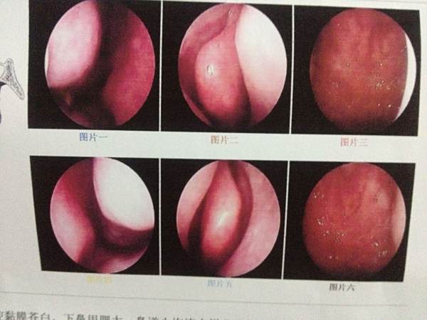 变应性鼻炎怎么回事