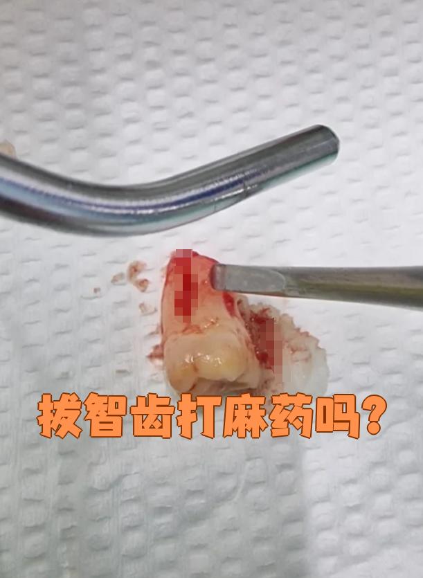 局部麻醉疼吗