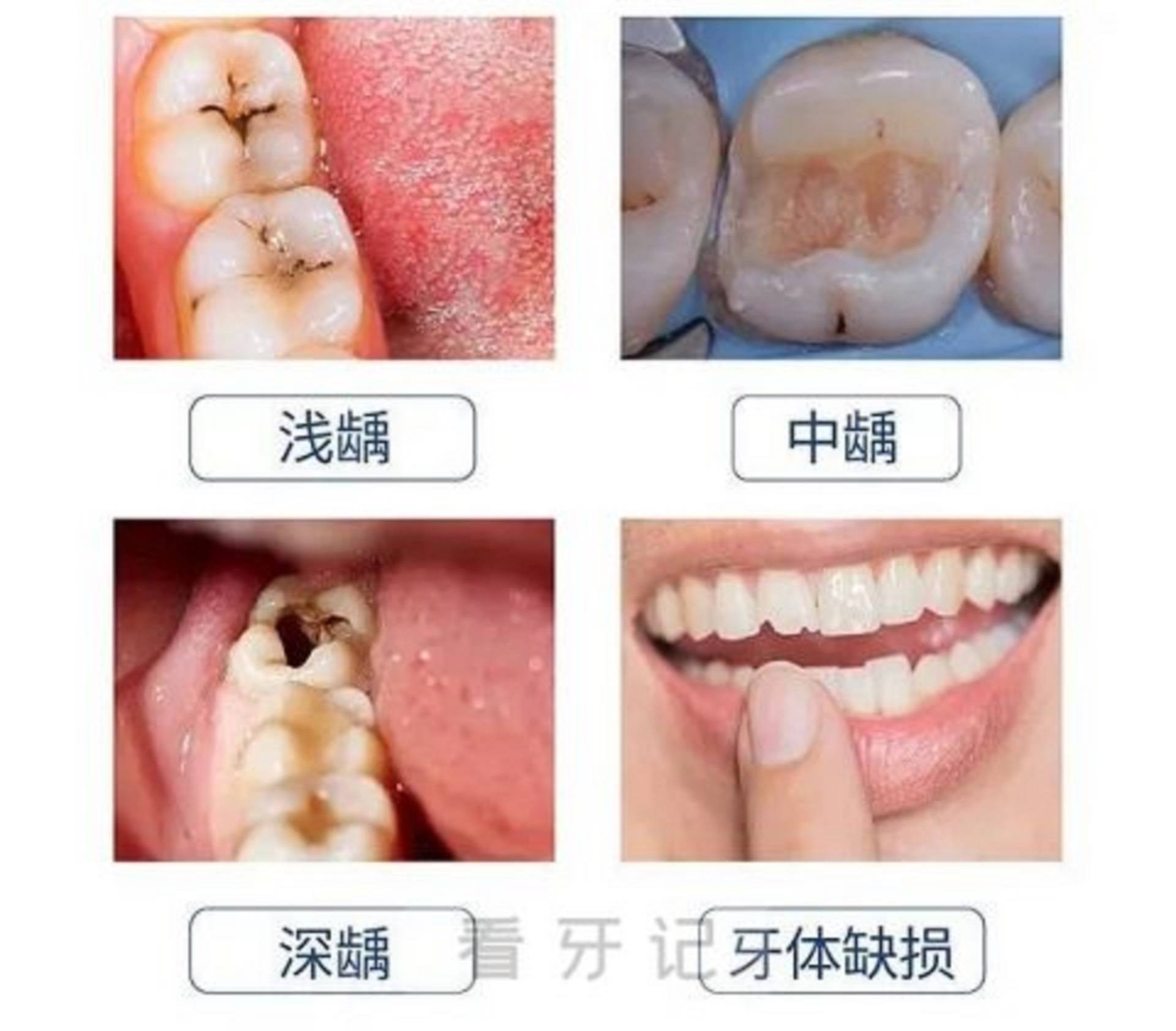 龋齿要怎么治疗