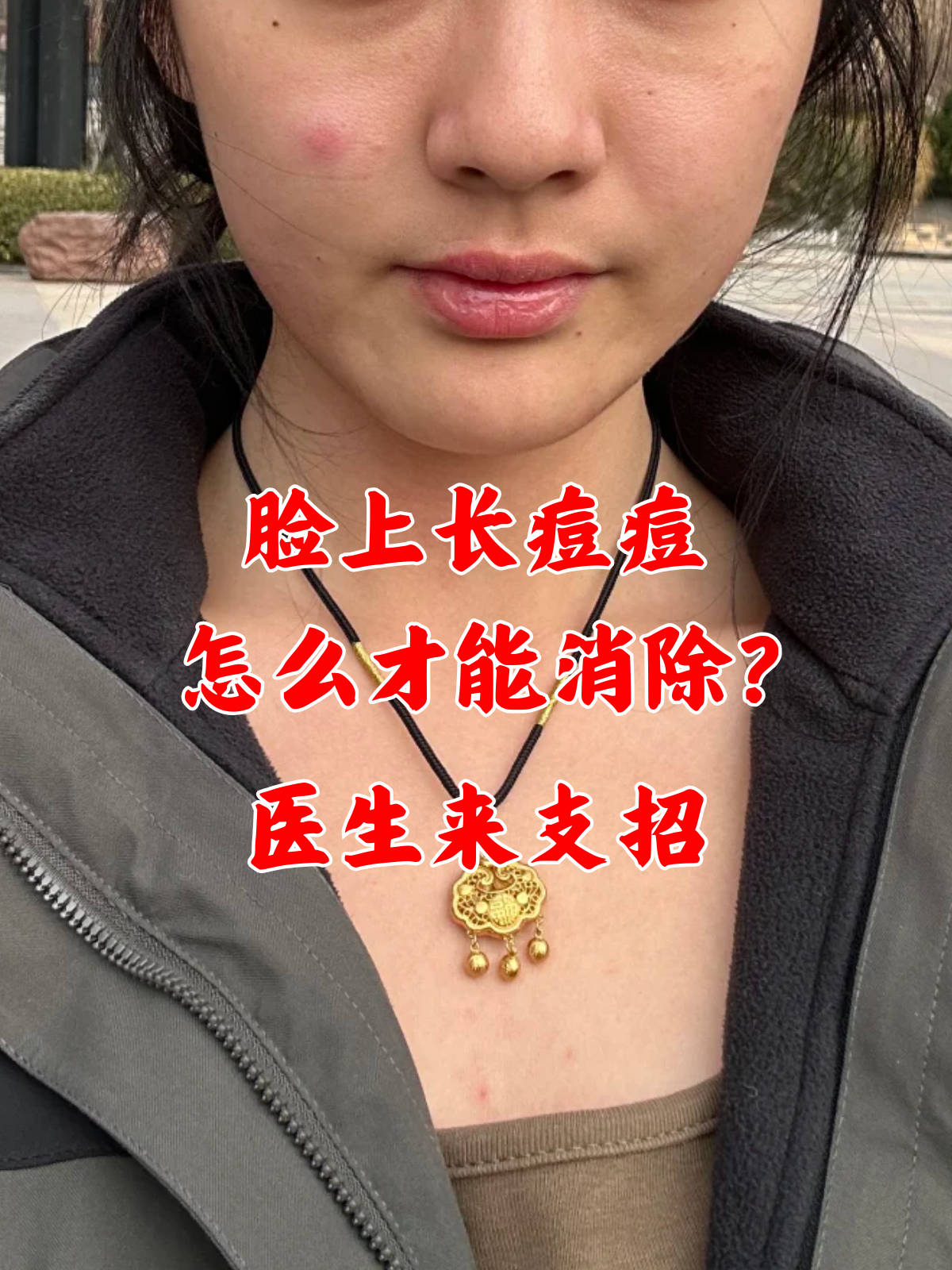 脸上长痘痘怎么办,医生