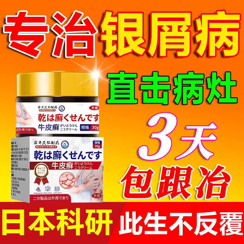 头部银屑病用什么药好?