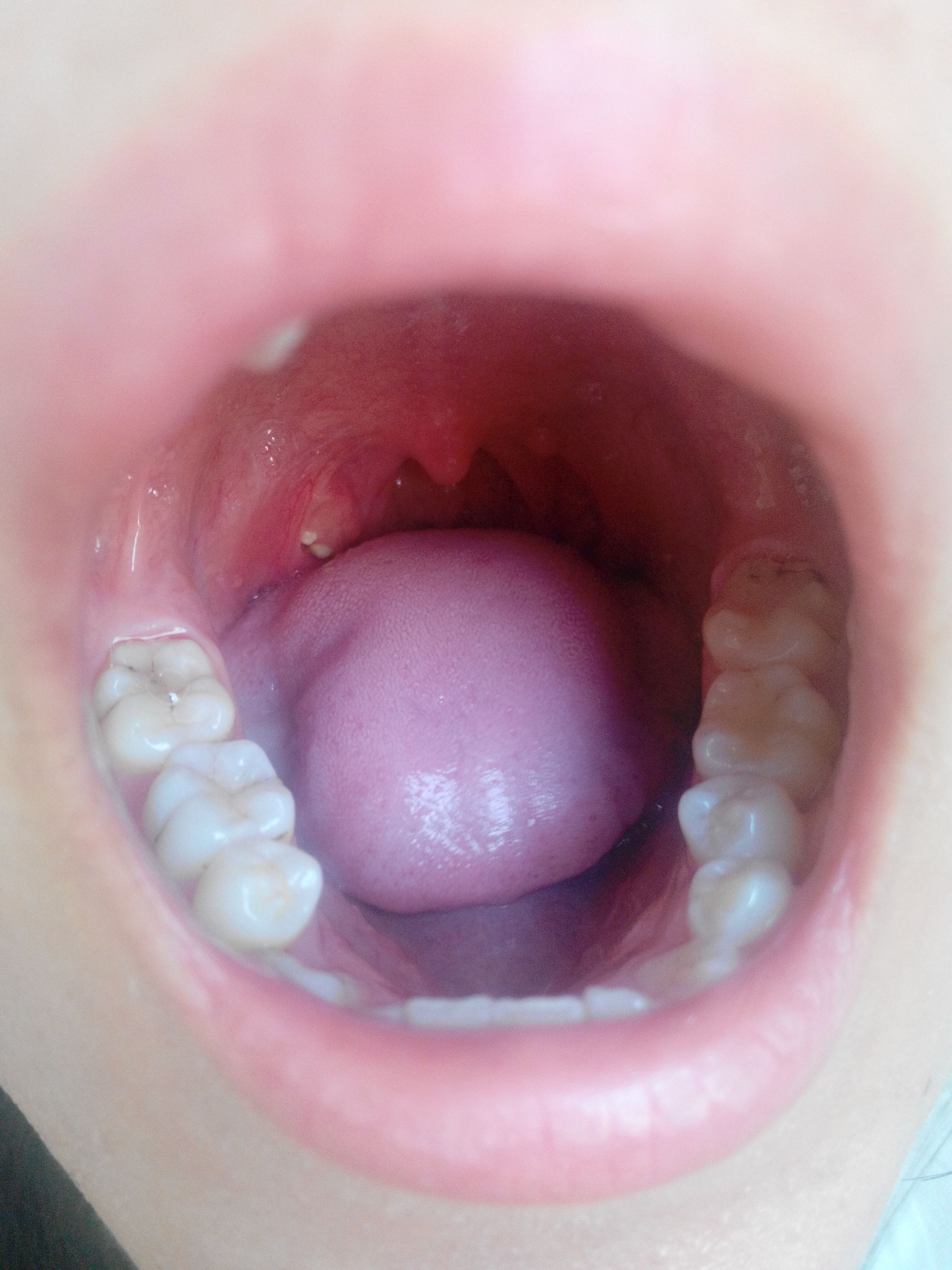 嗓子里有白色的东西是啥病