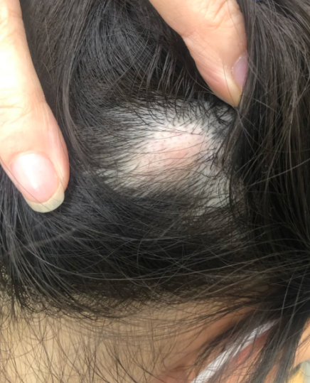 头顶不按不痛,一按着就痛