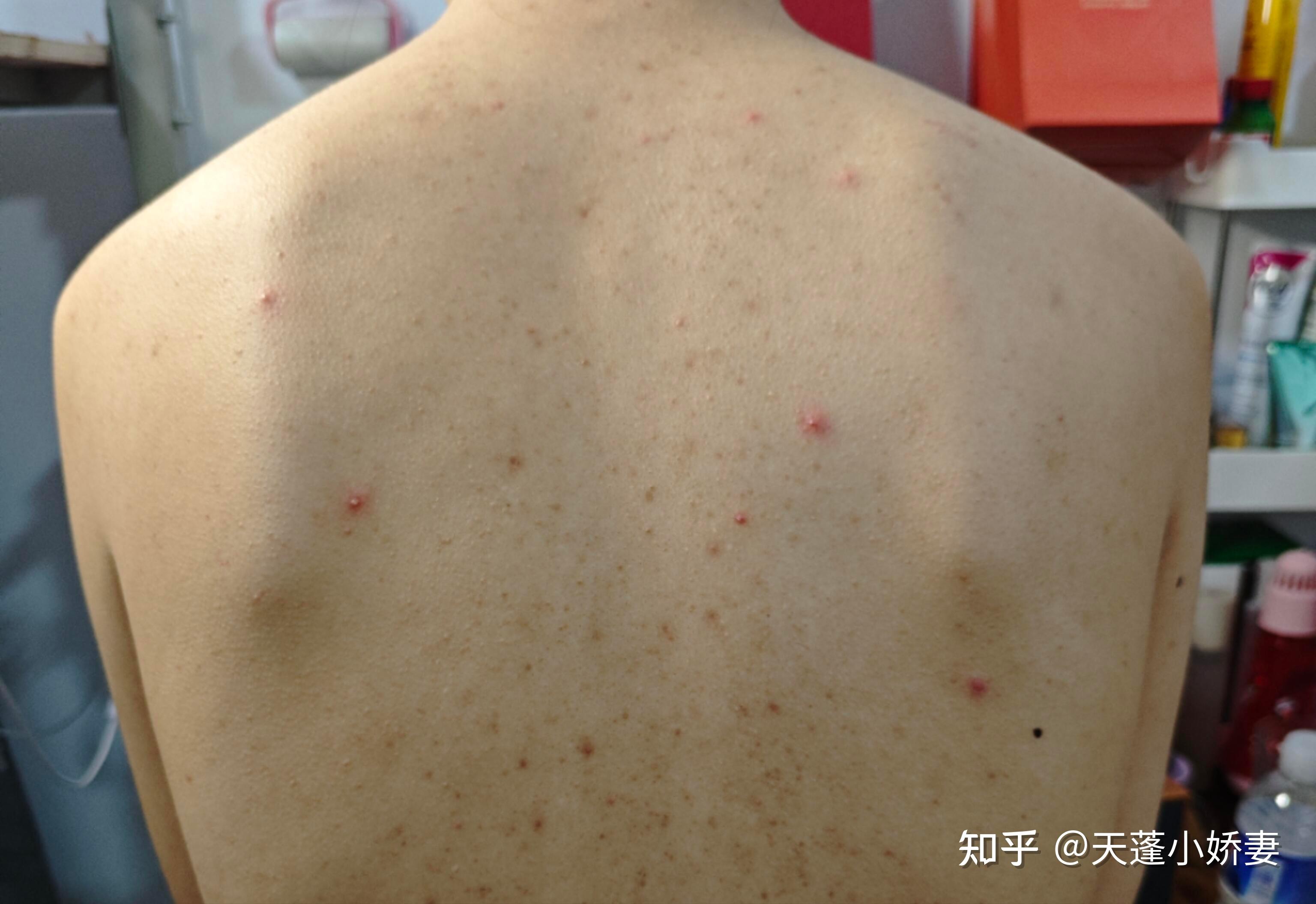 后背起疙瘩,越来越大