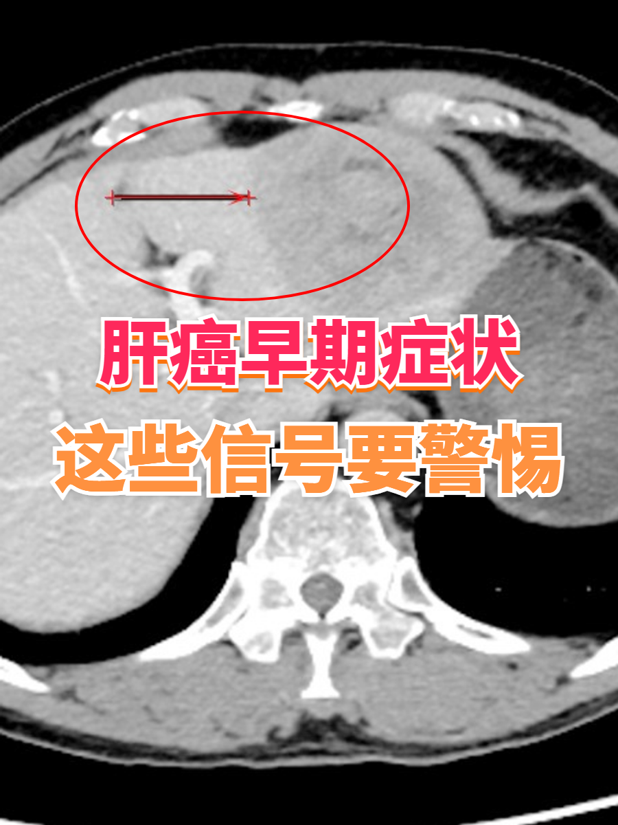 肝癌的前兆有什么症状?