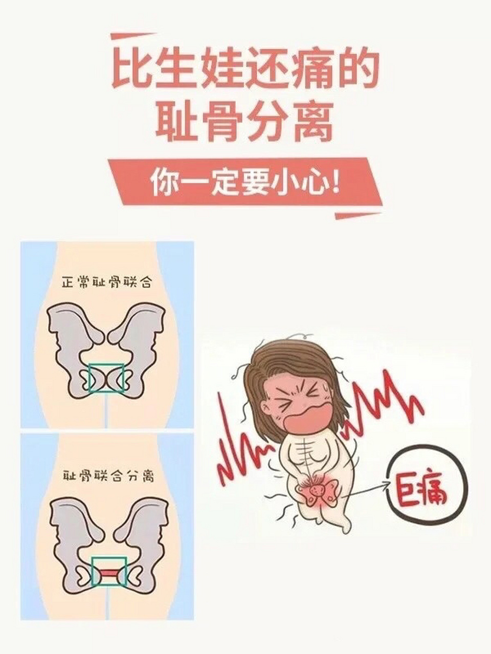 孕妇耻骨疼是什么原因引起的