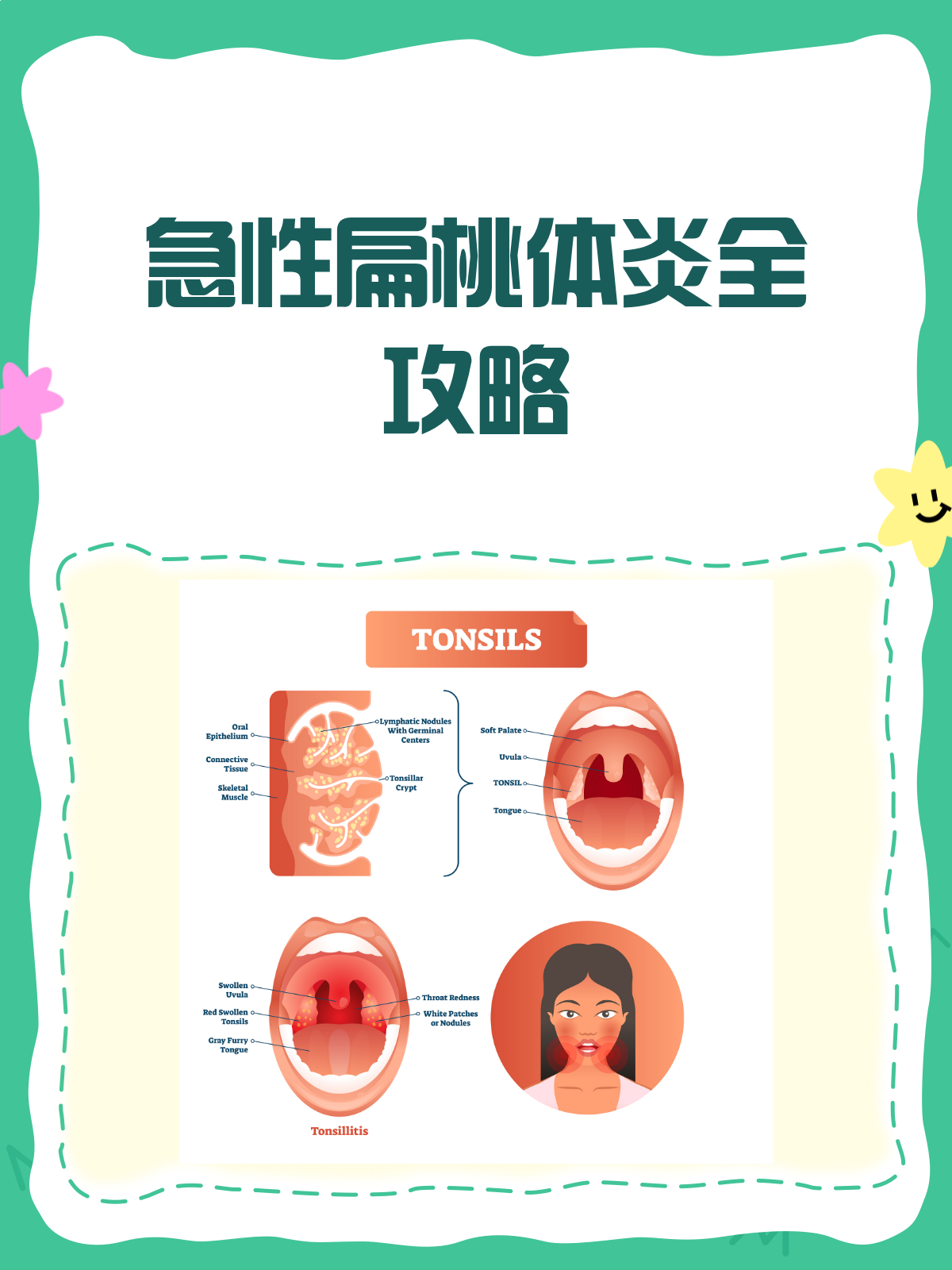 治疗急性扁桃体炎的方法有几种