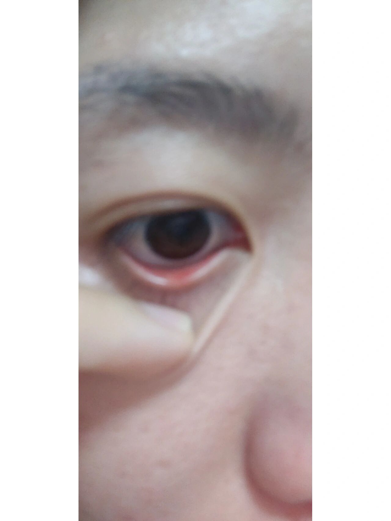 眼睛下面有白色小颗粒
