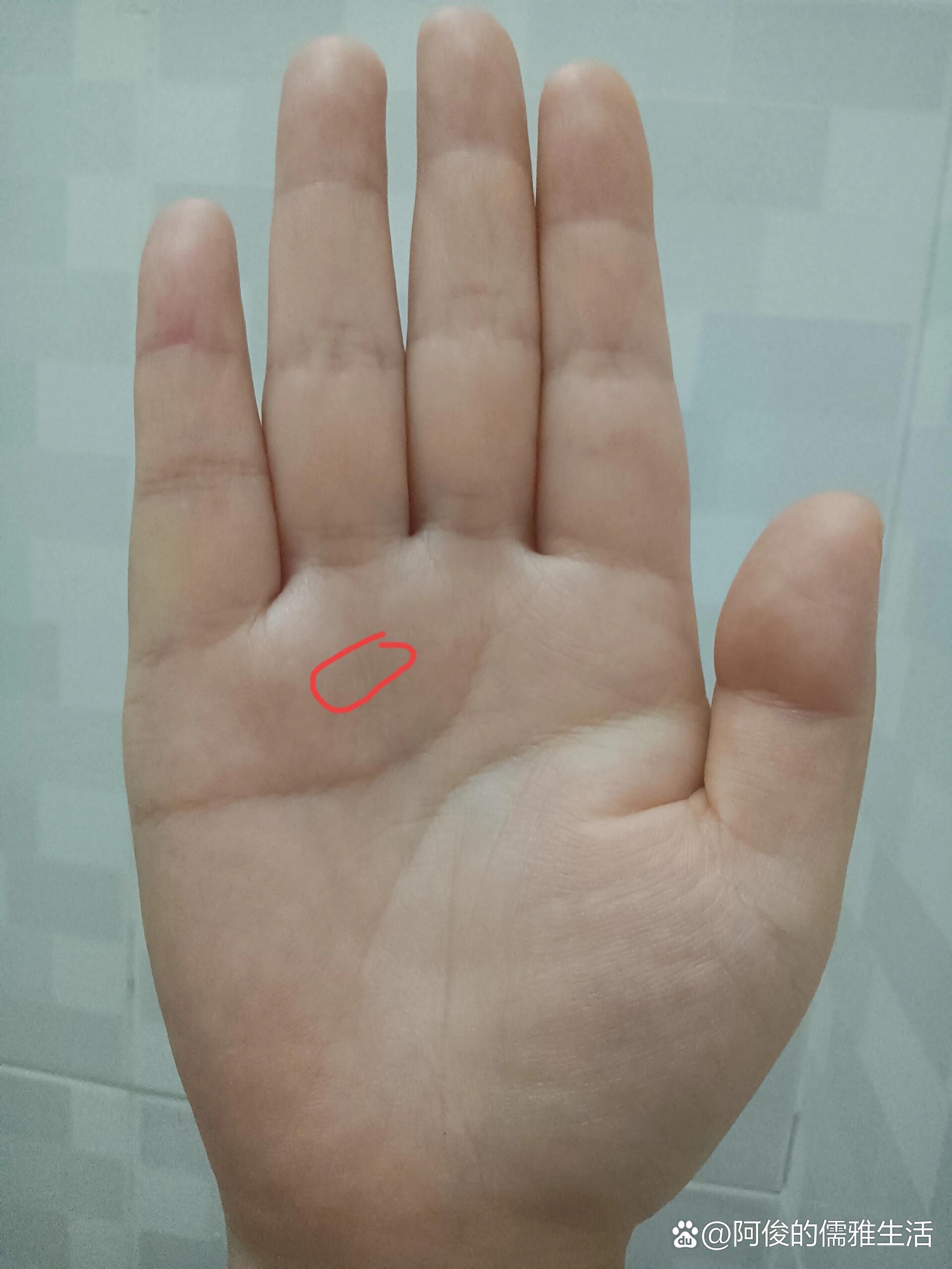 腱鞘囊肿不治疗行吗