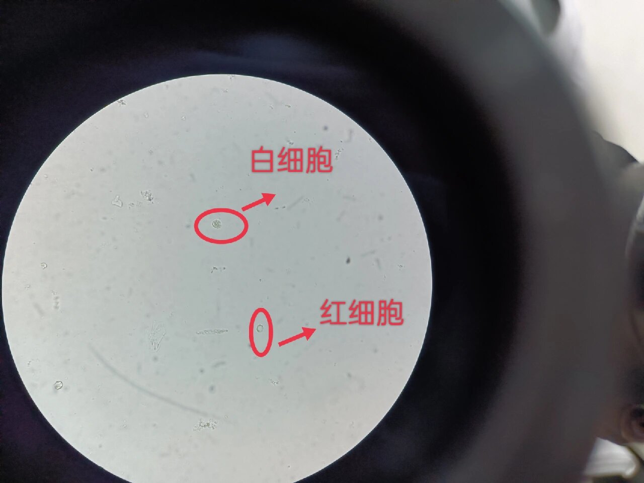 尿液中白细胞高是怎么回事