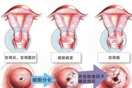 宫颈癌早期症状都有哪些