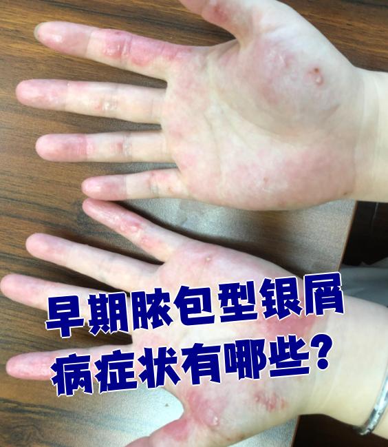 早期银屑病的症状