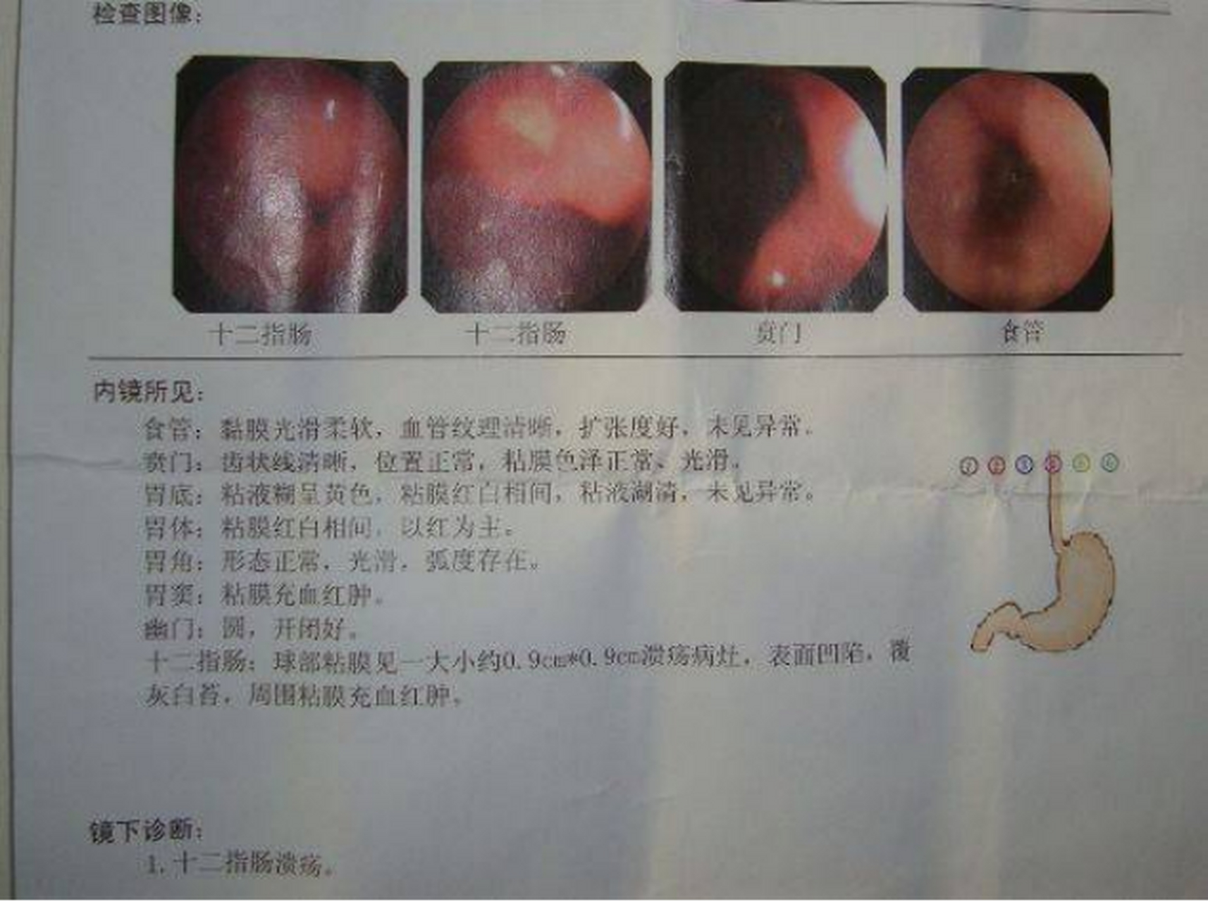 十二指肠溃疡的治疗方法是什么