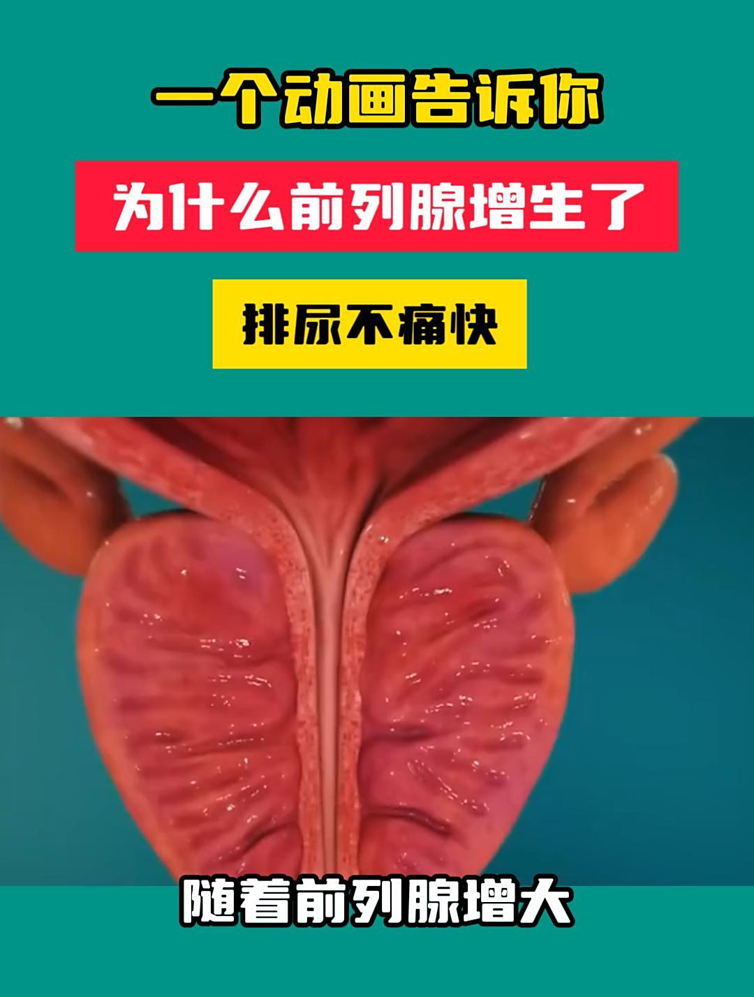 前列腺增生是怎么引起的?