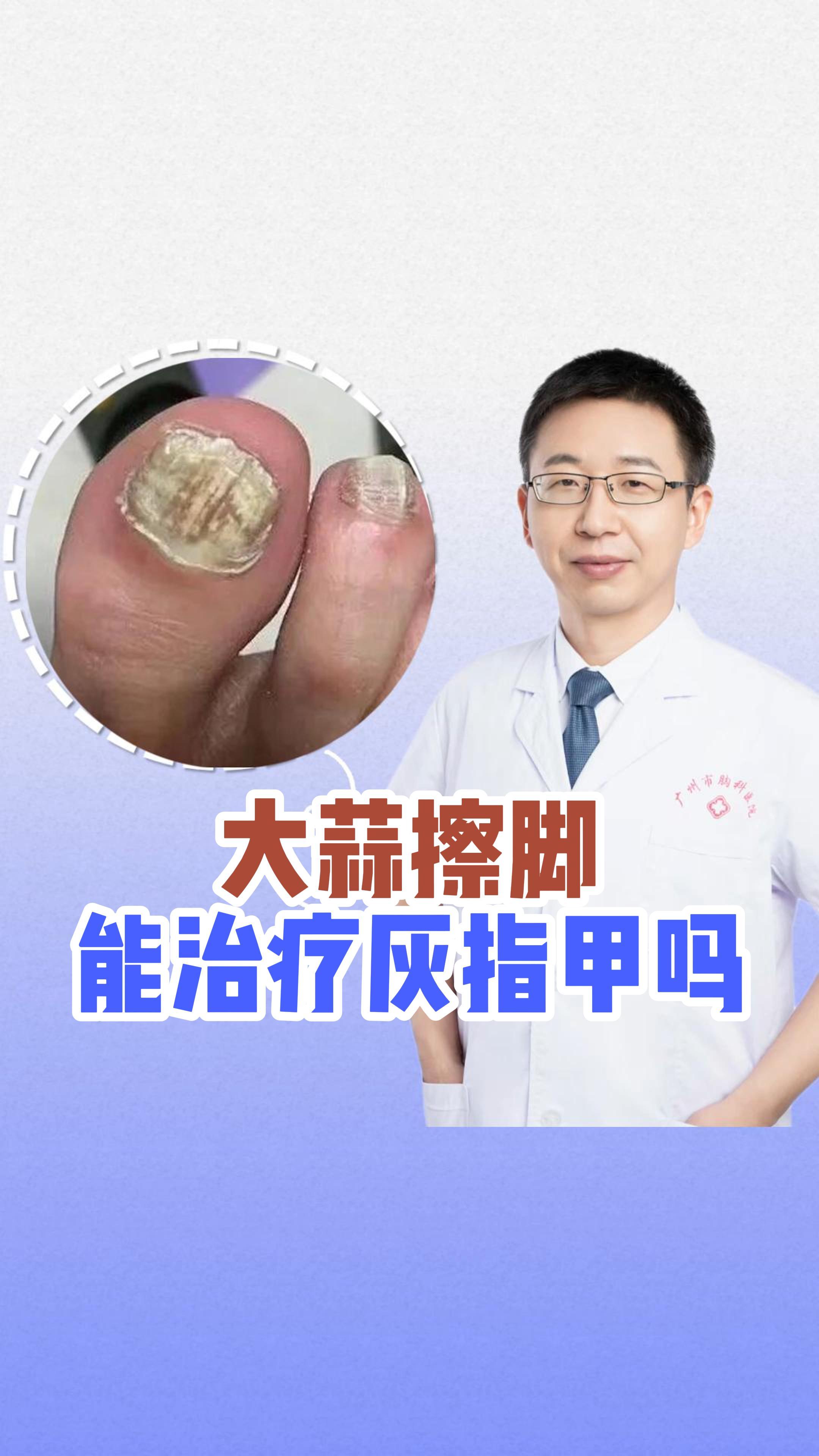灰指甲能自愈吗?