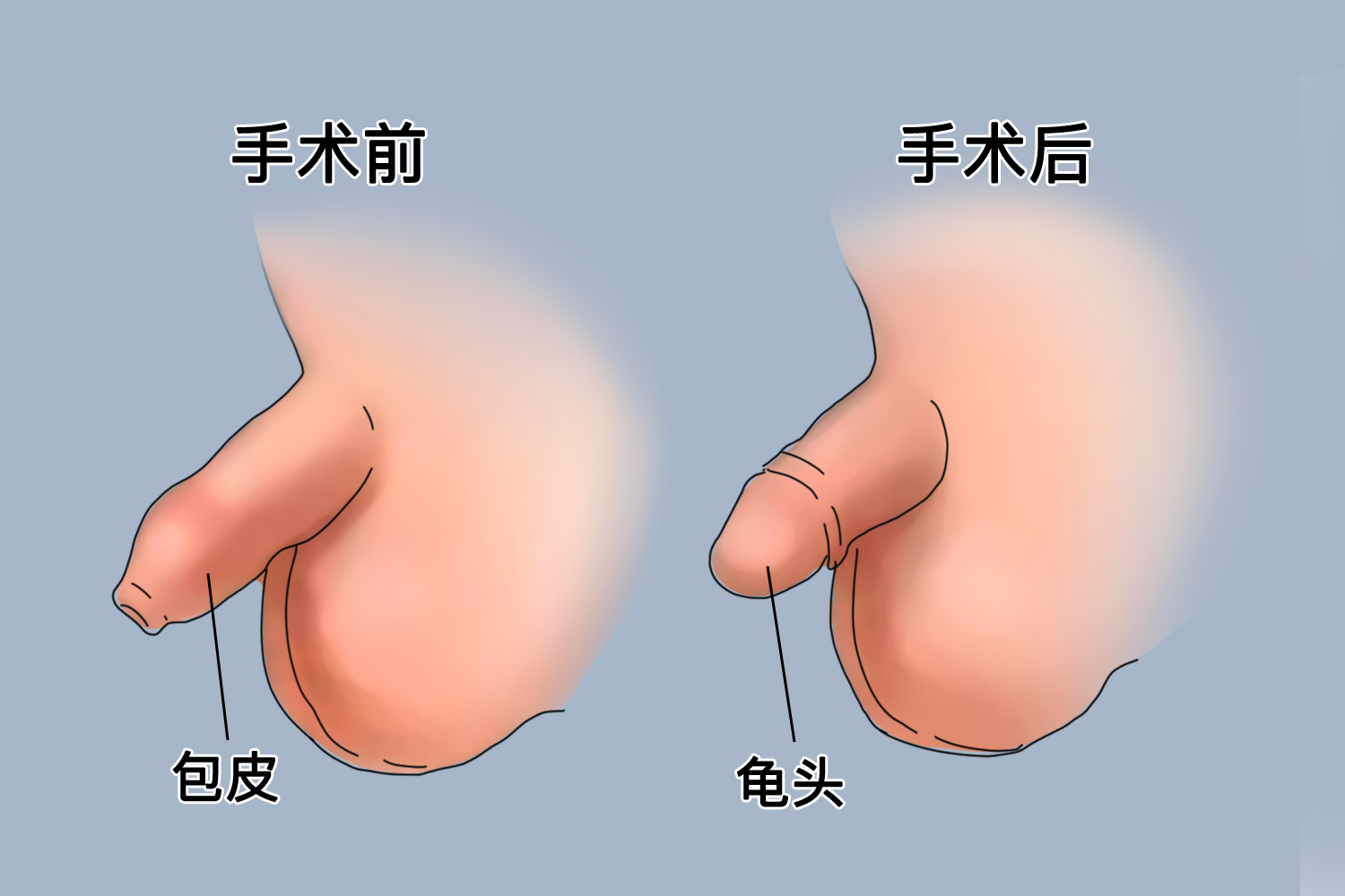 包皮商环手术