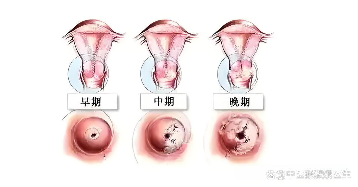 宫颈糜烂会影响怀孕吗
