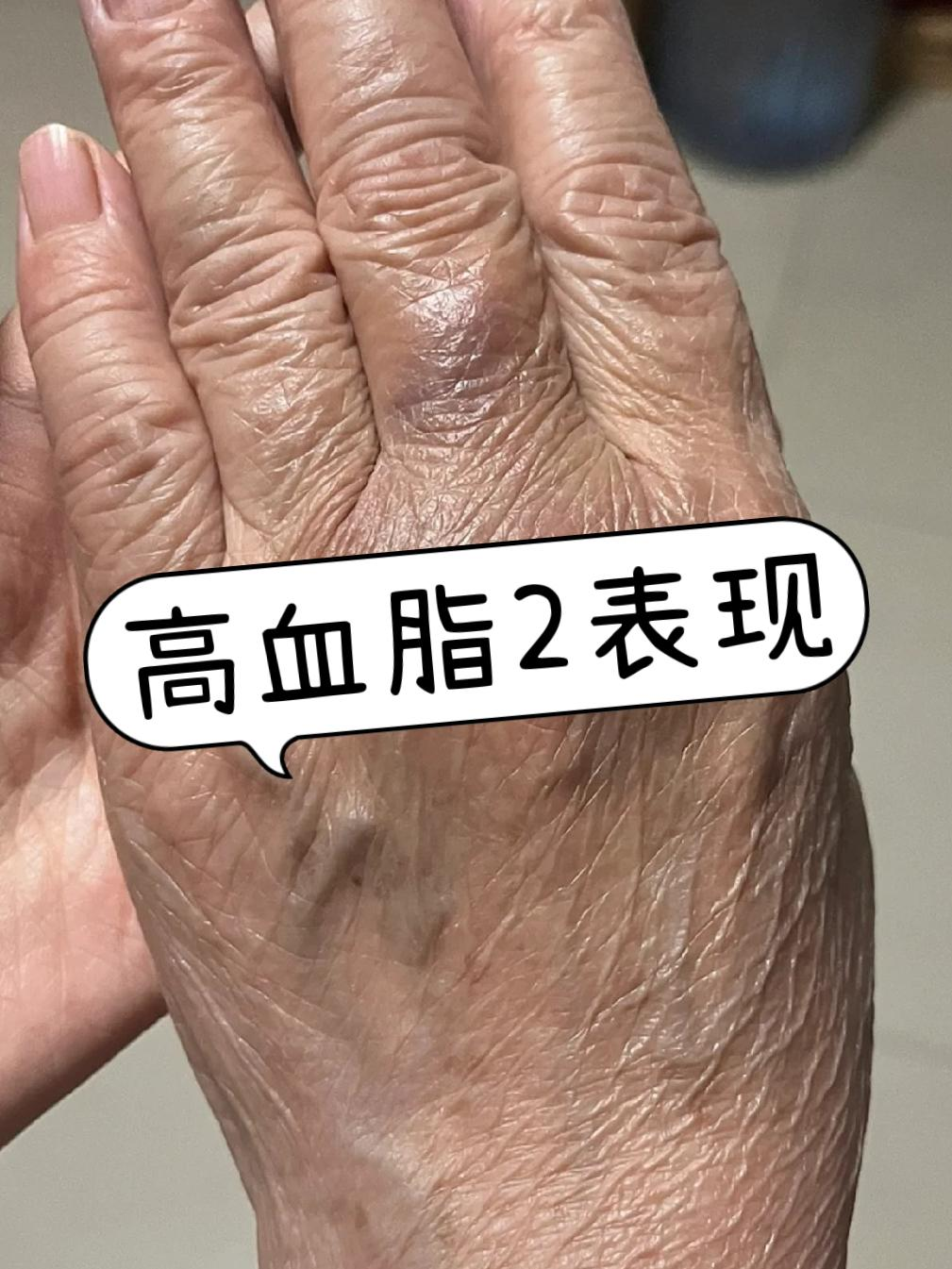 血脂高有什么症状