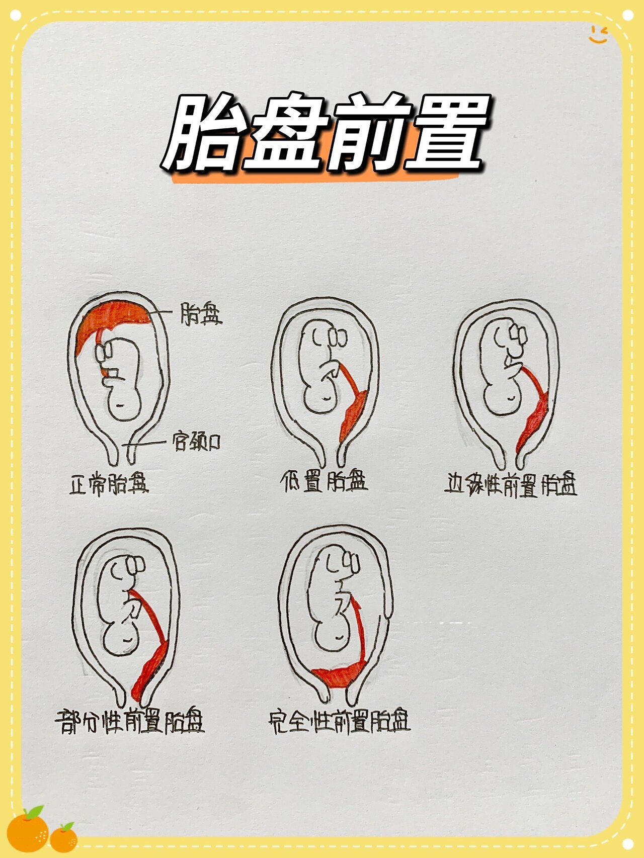 胎盘位于前壁什么意思
