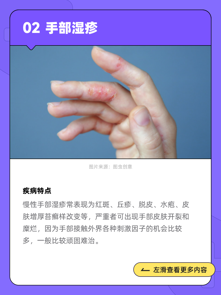 湿疹可以完全根治吗