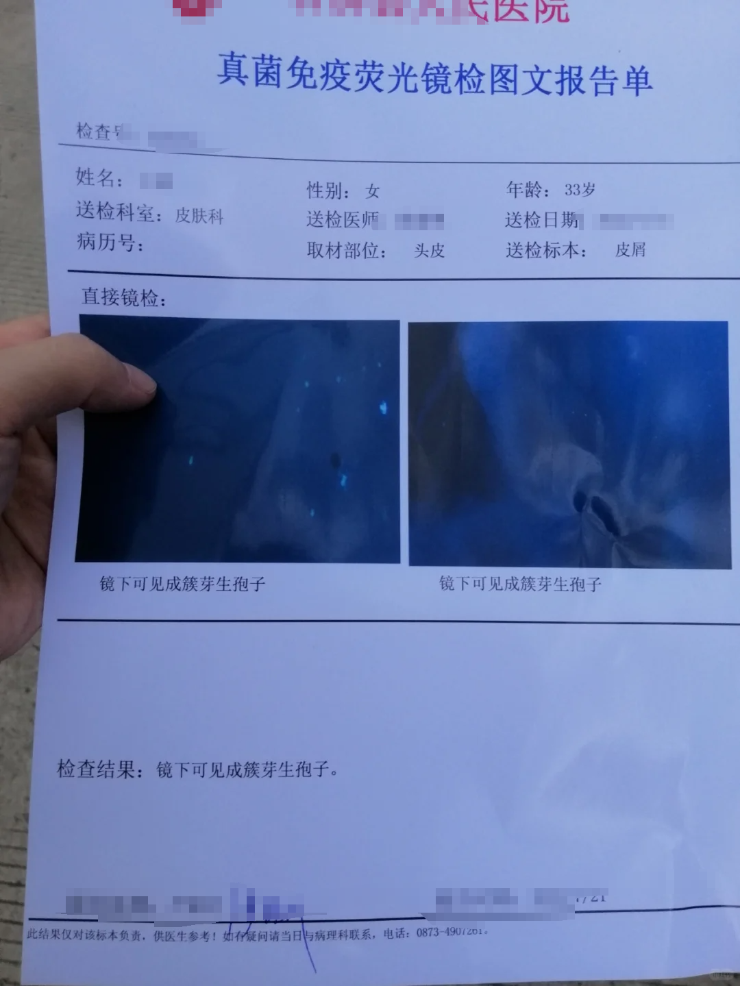 癣会传染吗