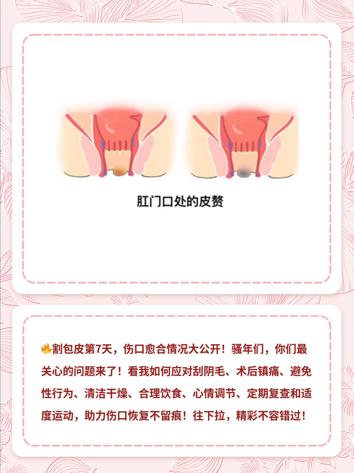 割包皮手术硬了这样正常吗,有图片