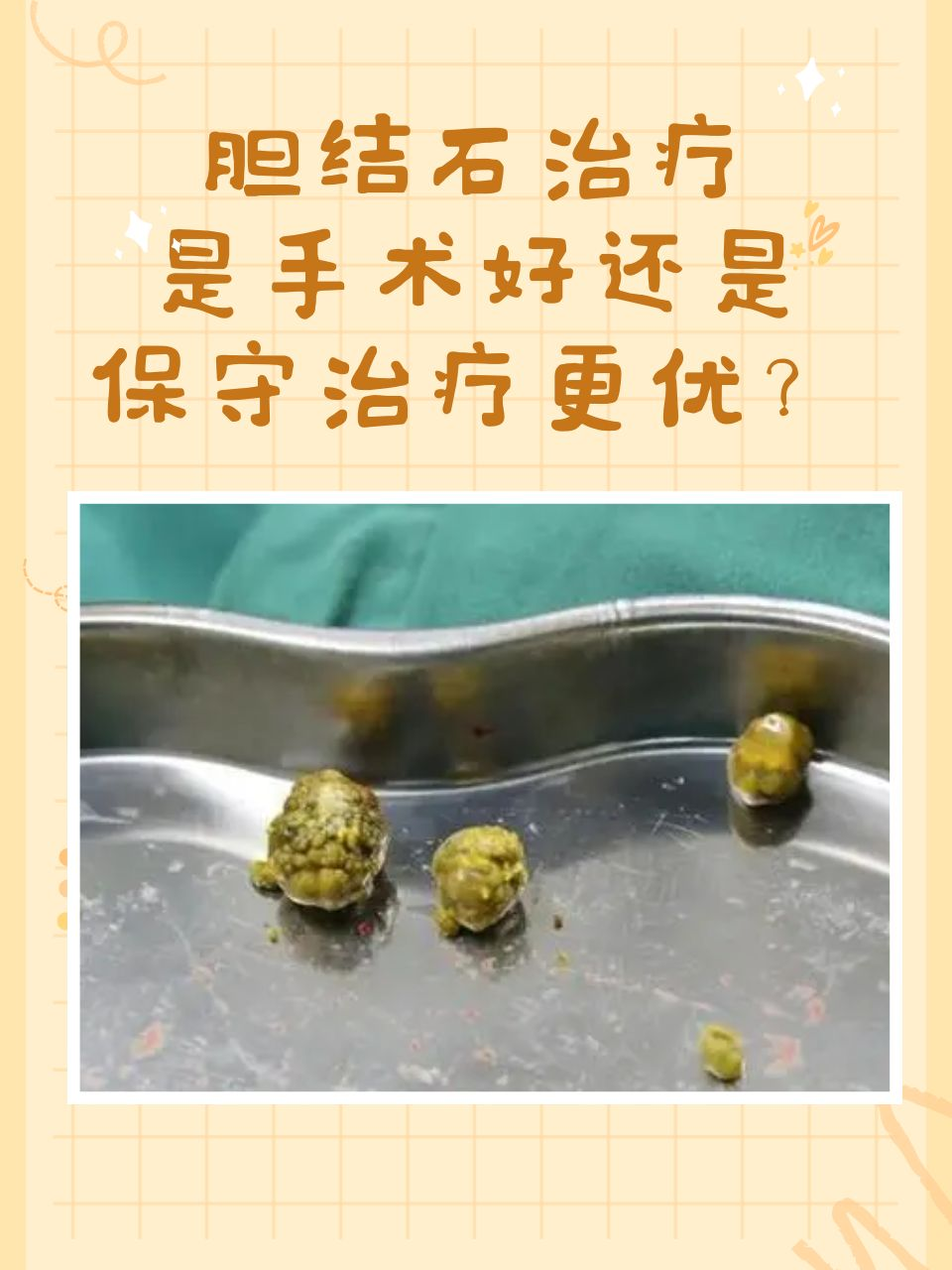 胆结石该如何治疗?