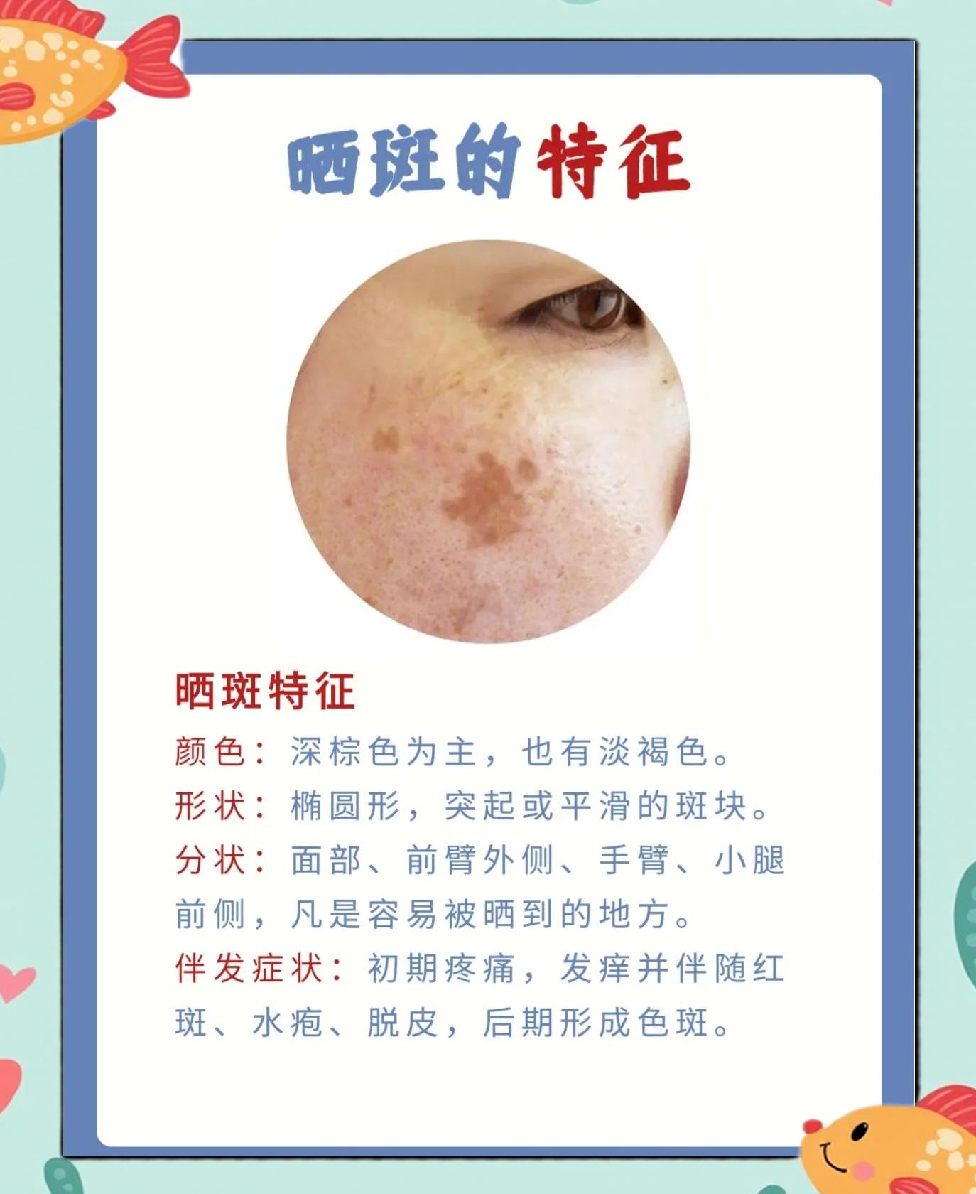晒斑的去除自然的方法