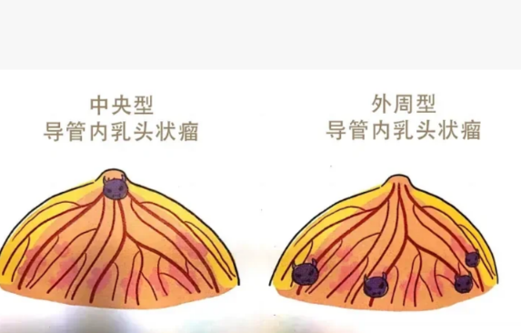 乳房肿块是什么