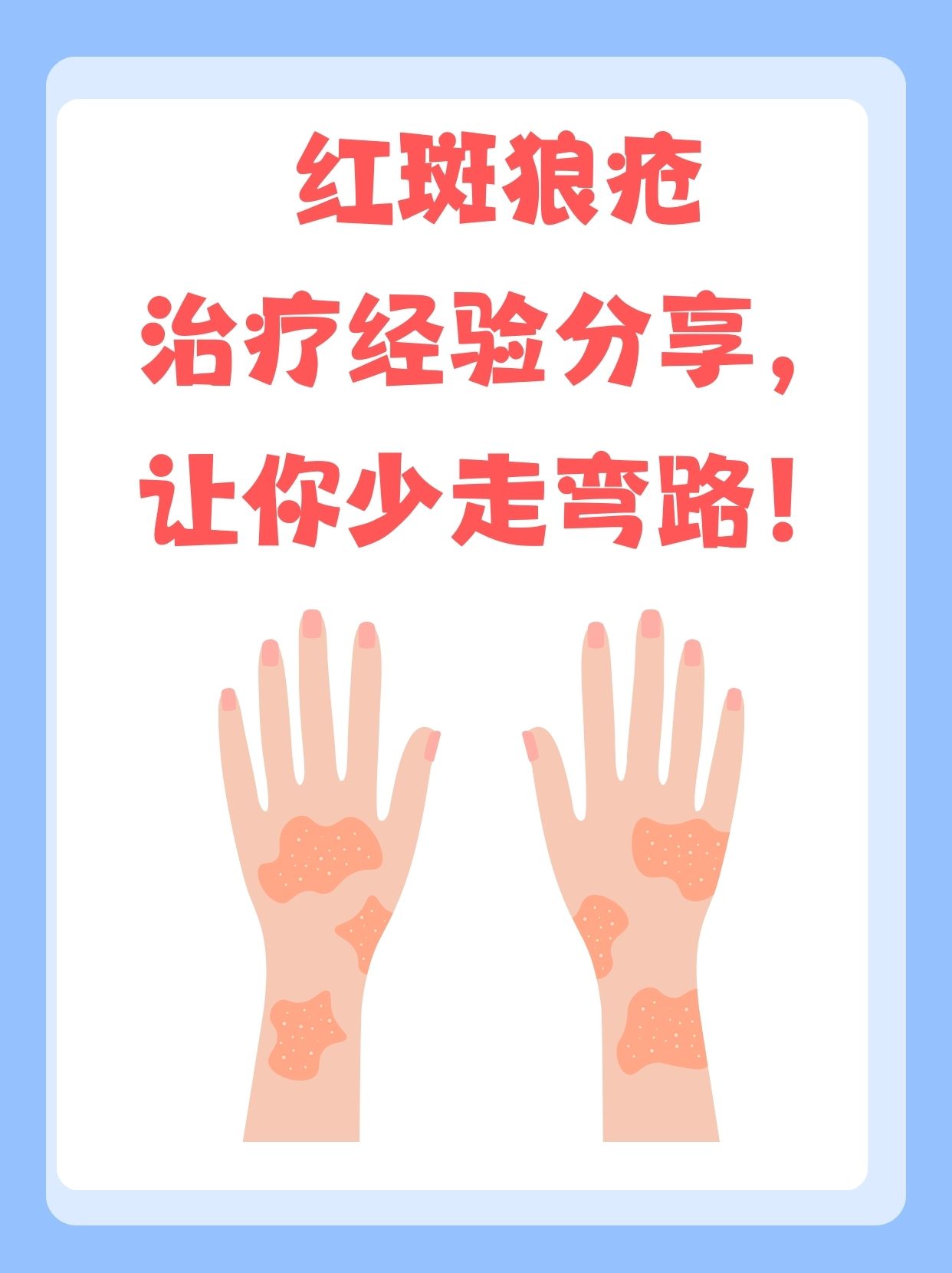 红斑狼疮活多久