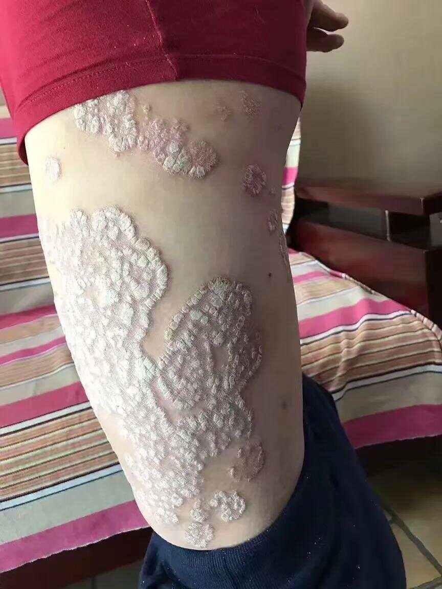 牛皮癣是怎么得的