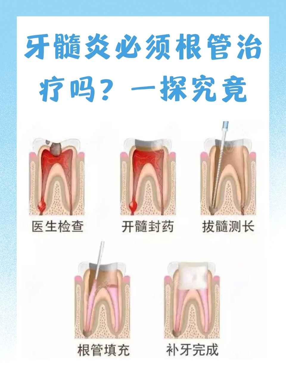 根尖炎治疗怎么办