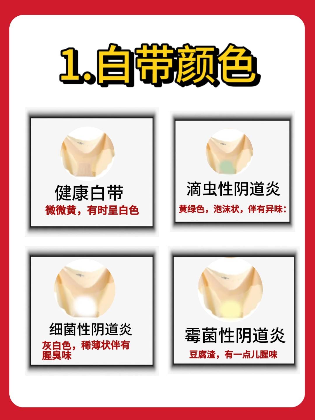 霉菌性阴道炎表现