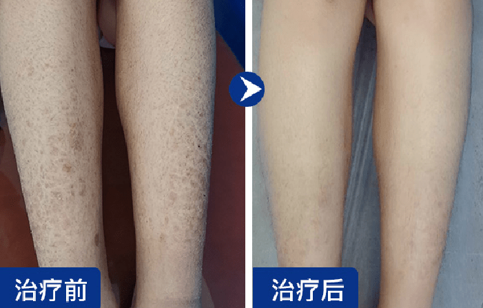 鱼鳞病如何治疗好