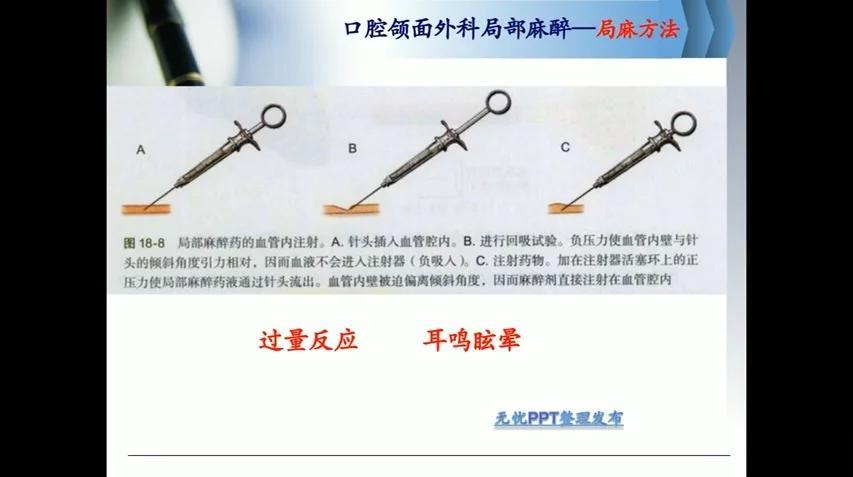 局部浸润麻醉方法