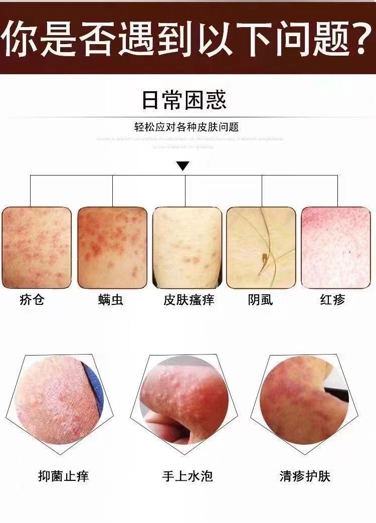 疥疮用硫软膏多久会死