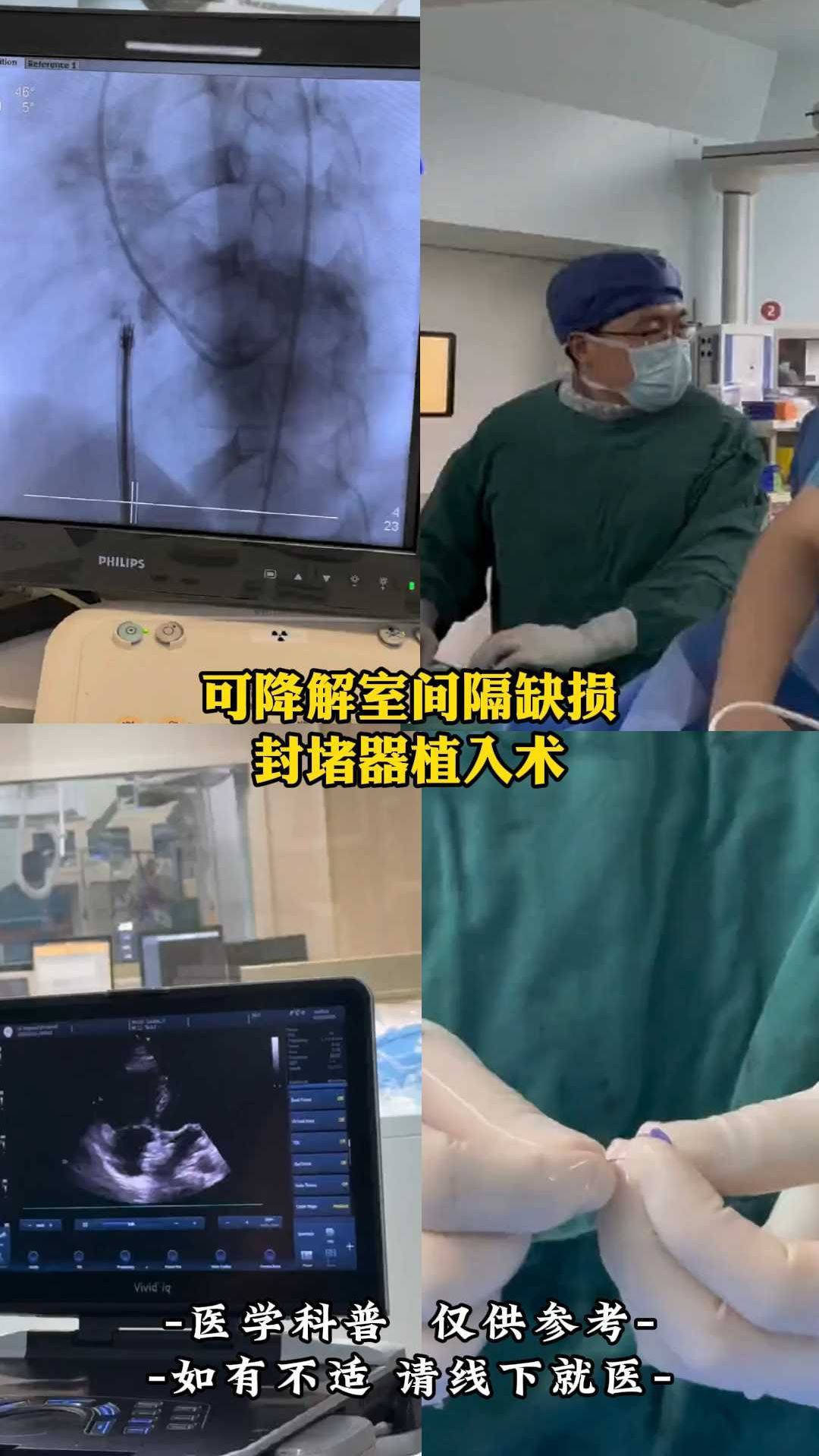 房间隔缺损手术怎么做