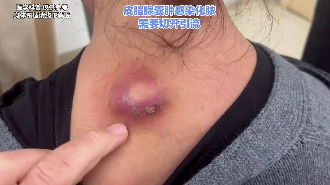 怎么会得皮脂腺囊肿