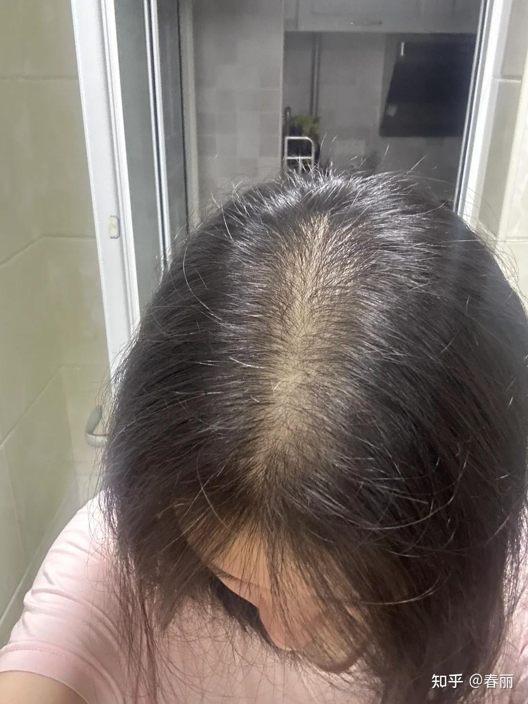 严重脱发是怎么回事