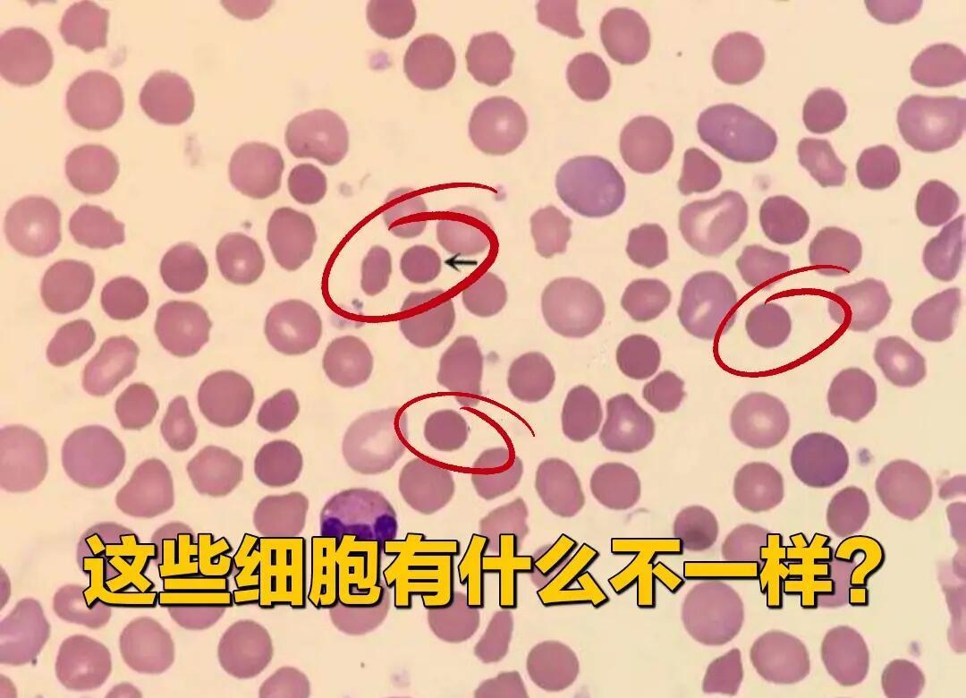 红细胞增多症