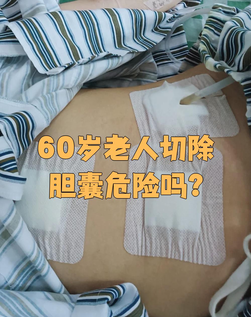 胆囊切除术后综合征是什么