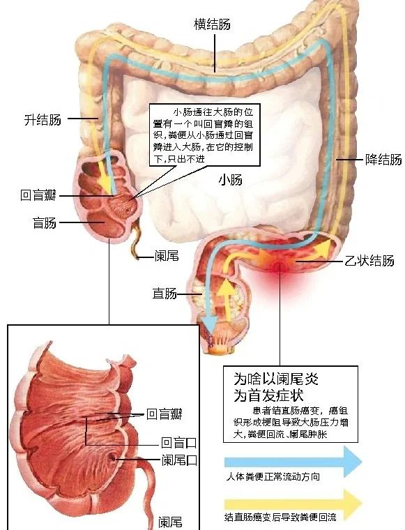 阑尾炎如何治疗好