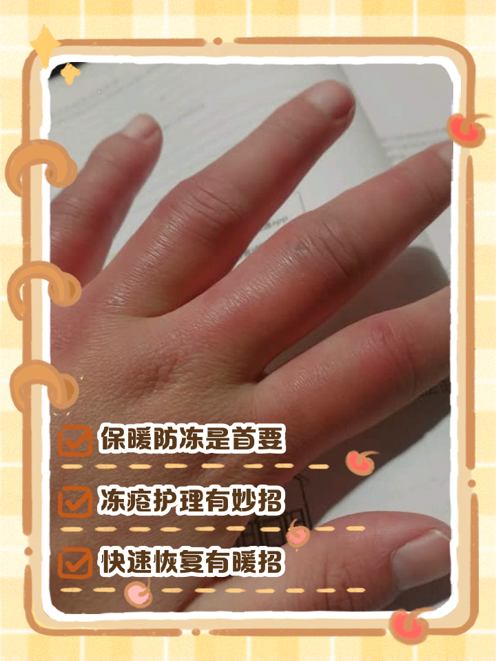 手被冻红了,肿了,怎么办