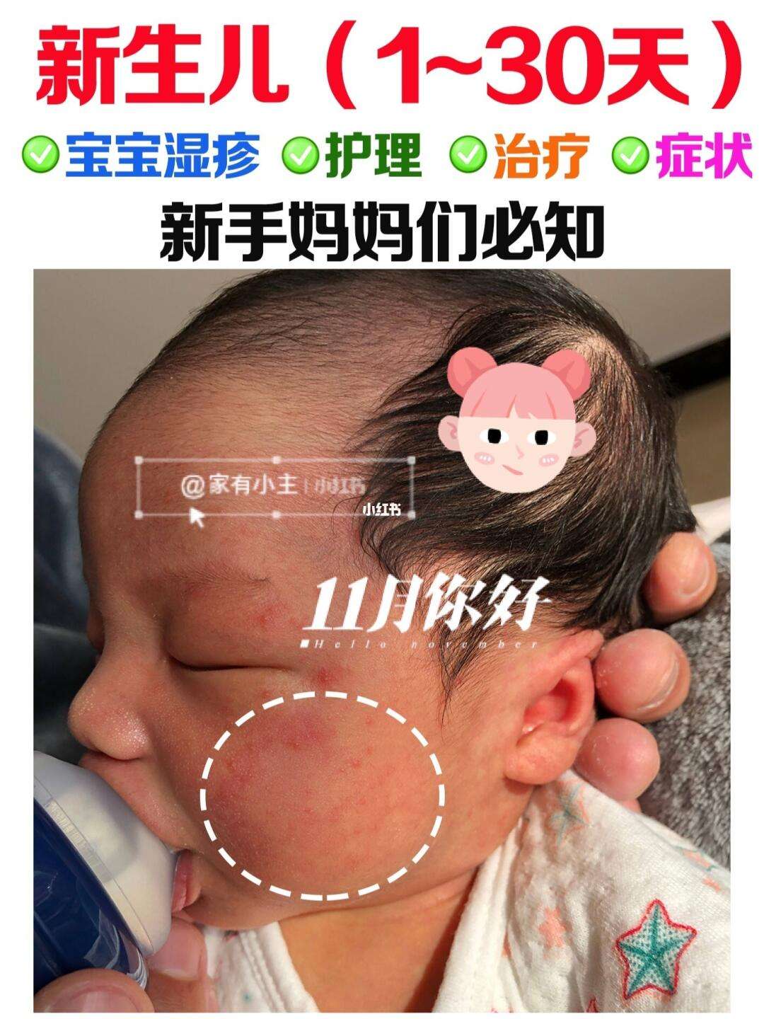 婴儿湿疹是怎么样的
