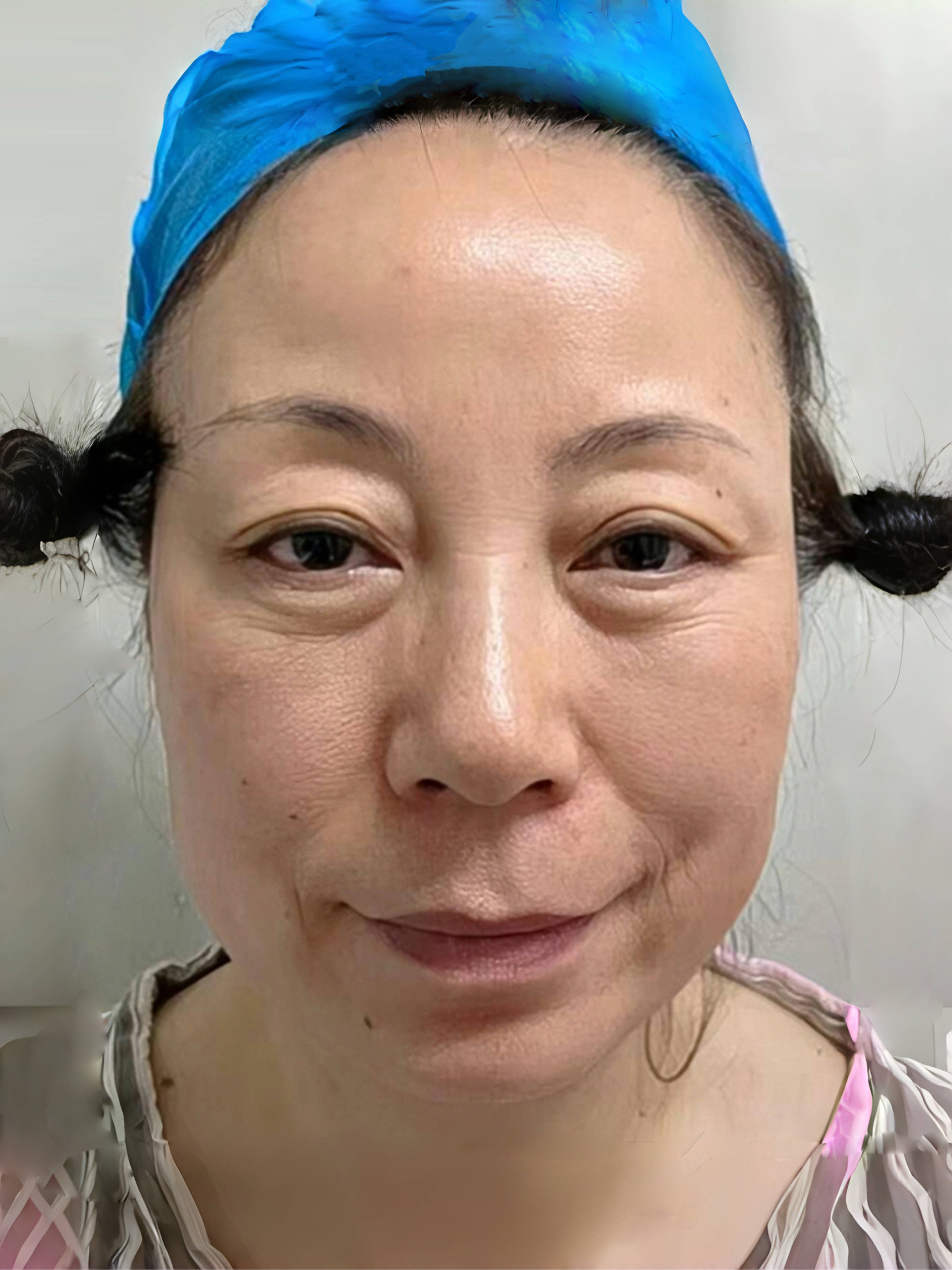 脸部线雕能保持多长时间