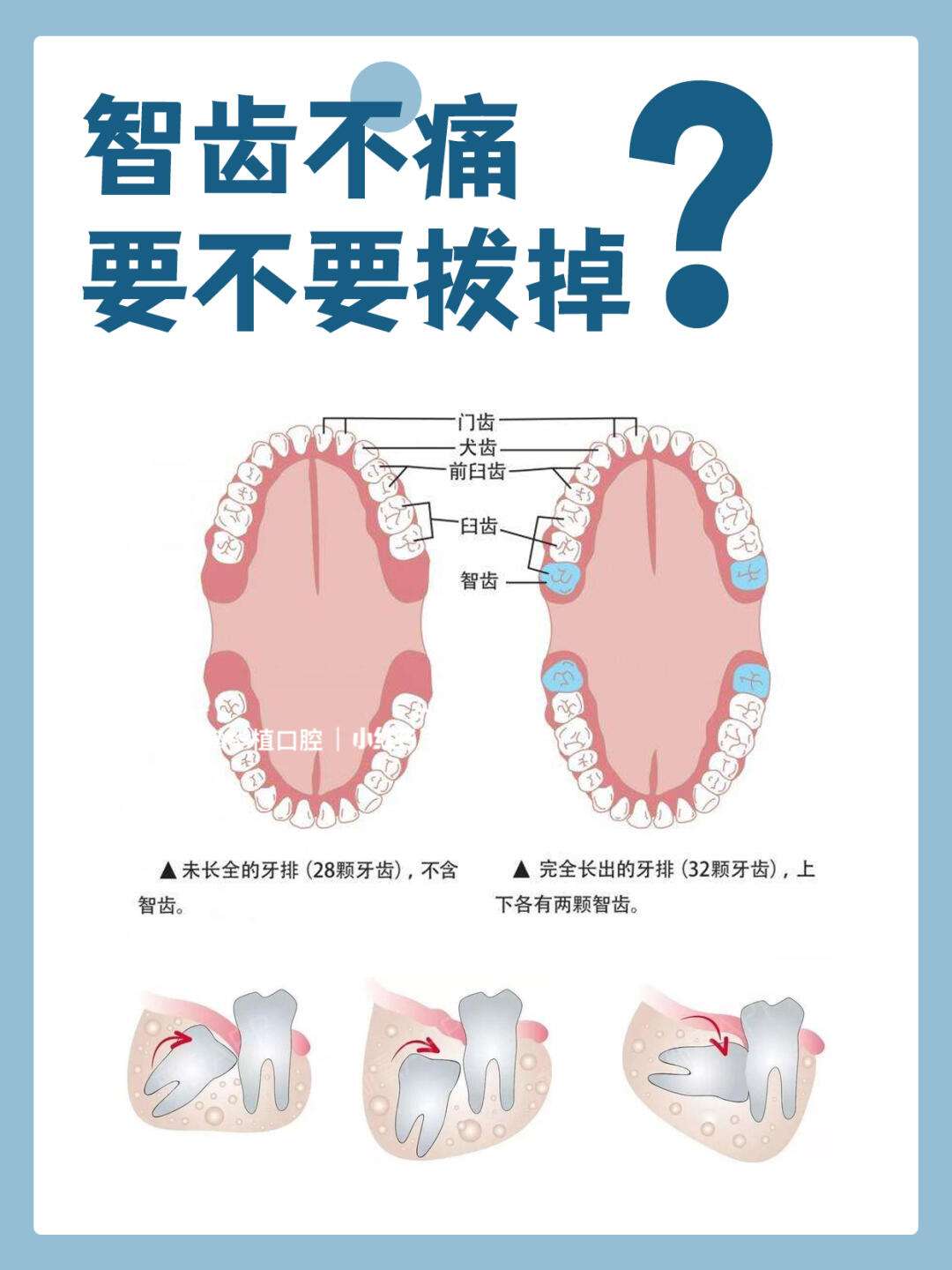 智牙痛一定要拔吗?